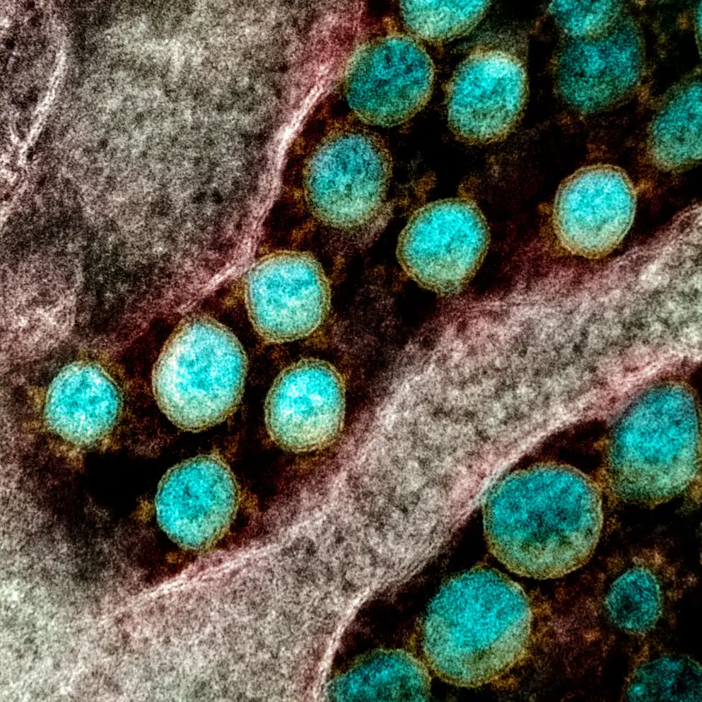 Colorized microscopy photo of SARS-CoV-2 particles in tissues